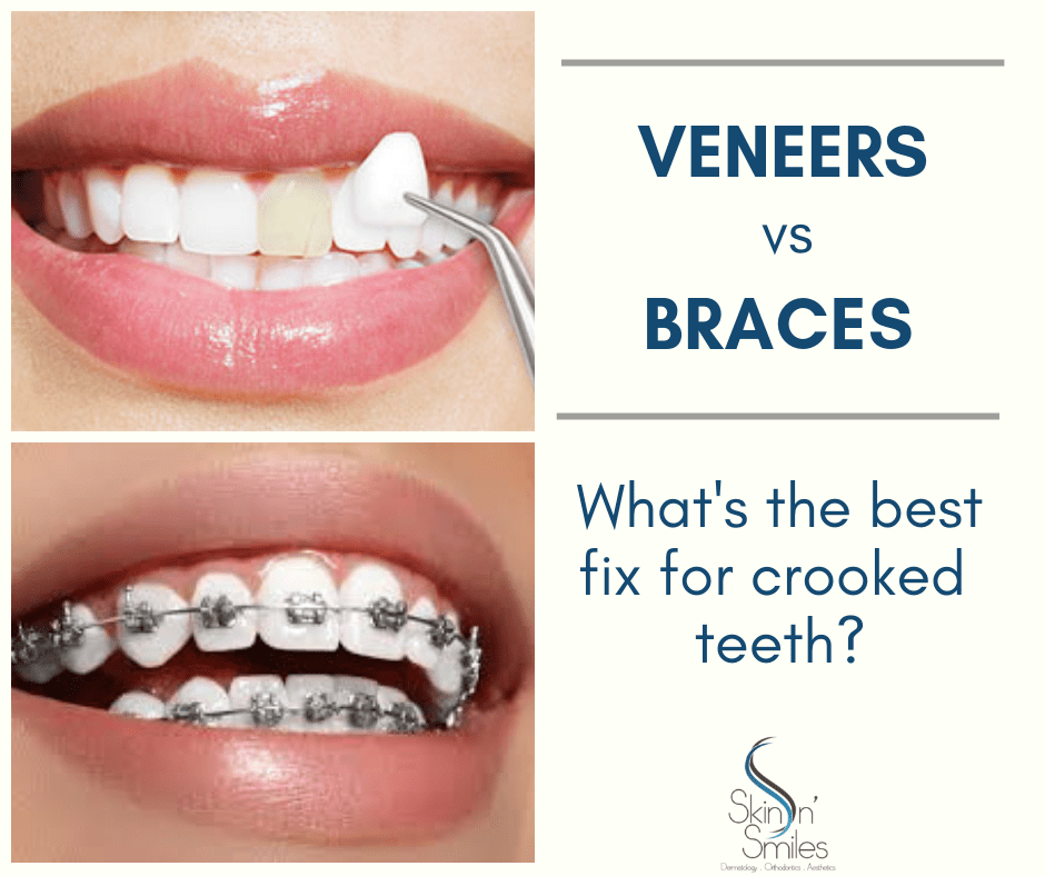 can veneers correct crooked teeth