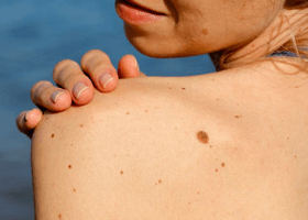 Mole/Wart/Skin-Tag Removal